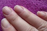 Dlaczego na paznokciach pojawiają się podłużne lub poprzeczne paski?