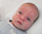 Kaip atrodo alergija kūdikiui?