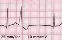 Dodatkowy skurcz zatokowy w EKG