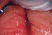 Gimdos kaklelio cervicito simptomai Bakterinis cervicitas