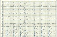 Kā kardiogrammā noteikt ārkārtas sirds kontrakcijas?
