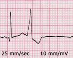 Dodatkowy skurcz zatokowy w EKG