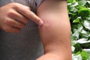 Чем опасны укусы насекомых – опасные последствия и средства первой помощи