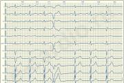 Kā kardiogrammā noteikt ārkārtas sirds kontrakcijas?